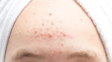 التوتر وحبوب البشرة: كيف يؤثر الضغط النفسي على الجلد وكيفية التعامل معه بفعالية